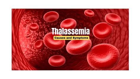 Beta Thalassemia: What You Should Know .